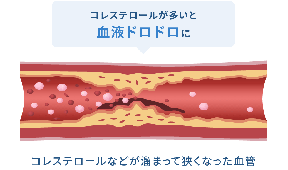 コレステロールなどが溜まって狭くなった血管 コレステロールが多いと血液ドロドロに